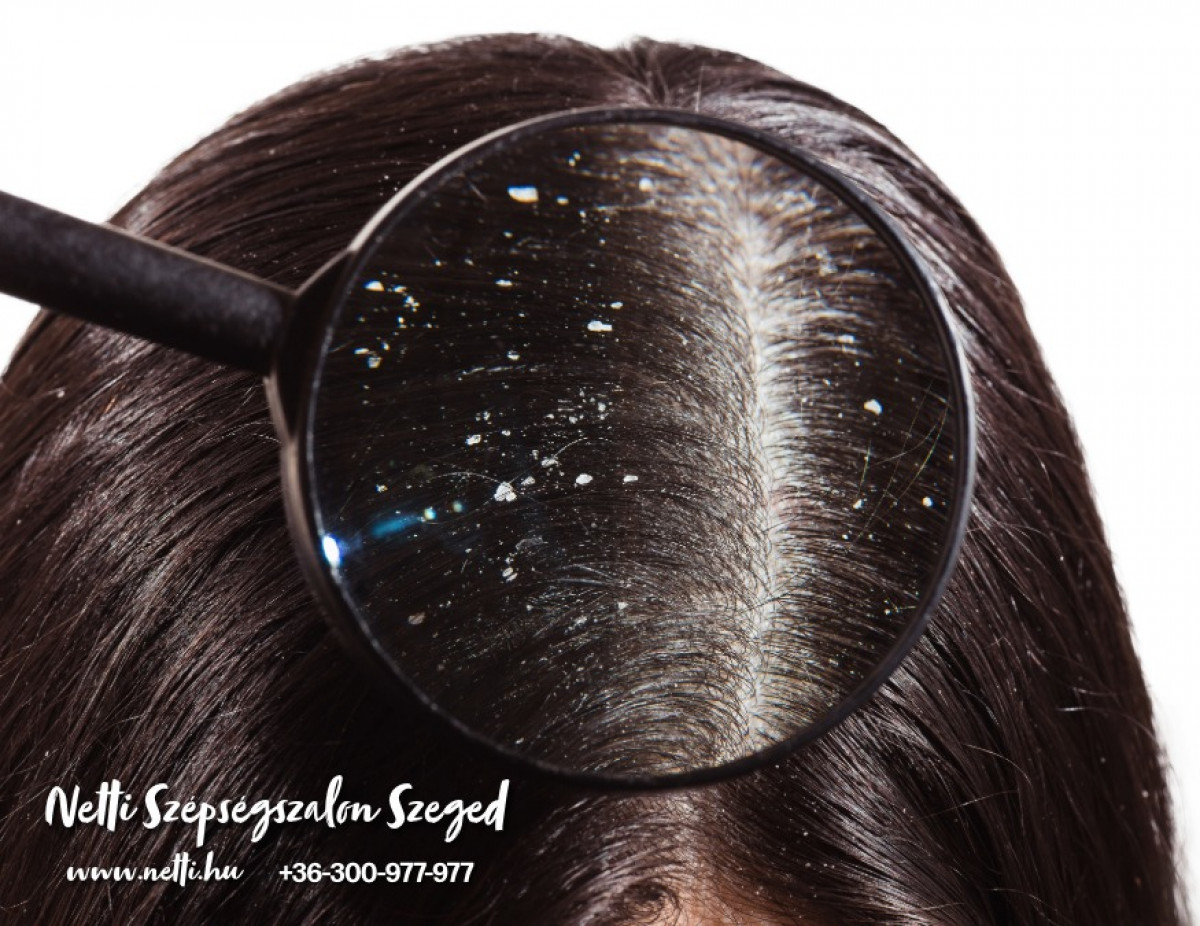 Korpa vagy pikkelysömör? Mutatjuk, hogyan dönthetjük el – Netti Beauty Szépségszalon, Szeged