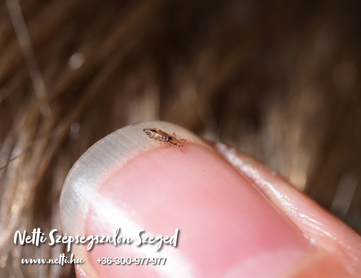 Őszi fejtetvesség – Mire figyeljünk szülőként?