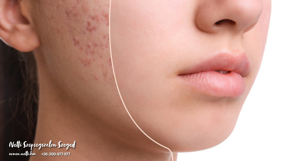 Pattanásos bőr kezelése - Netti Szépségszalon Szeged