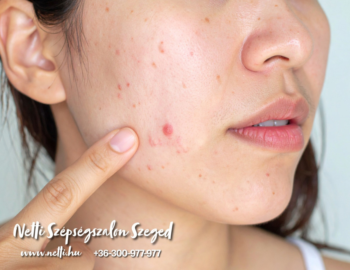 Pattanások - Kozmetika Szeged - Pattanáskezelés