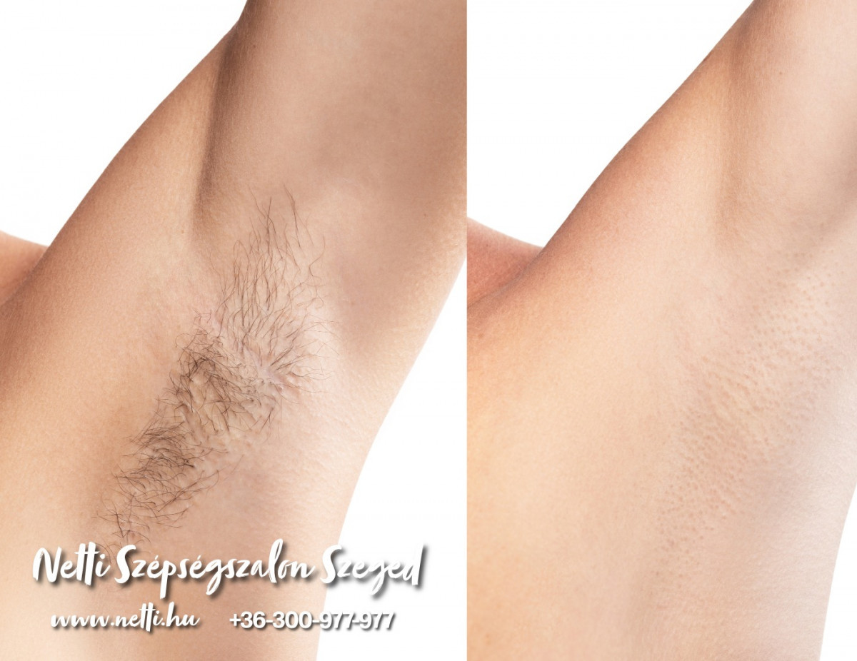 Szőrtelenítés - gyantázás, epilálás